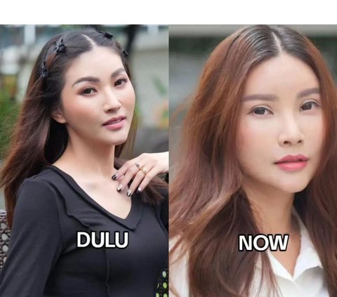 10 Artists Before VS After Plastic Surgery in 2024, Mahalini Raharja & Rizky Febian Instead Get Mocked