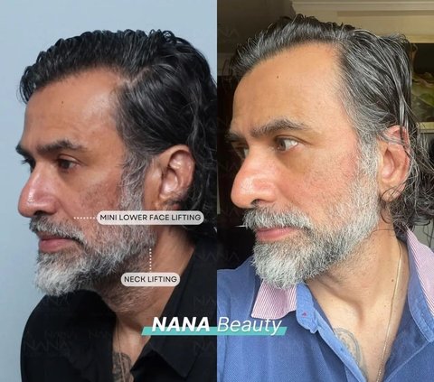 10 Artists Before VS After Plastic Surgery in 2024, Mahalini Raharja & Rizky Febian Instead Get Mocked