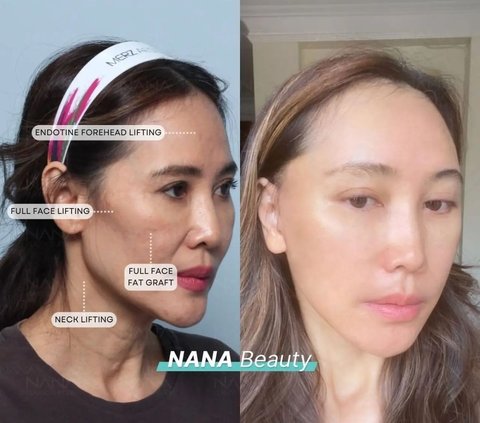 10 Artists Before VS After Plastic Surgery in 2024, Mahalini Raharja & Rizky Febian Instead Get Mocked