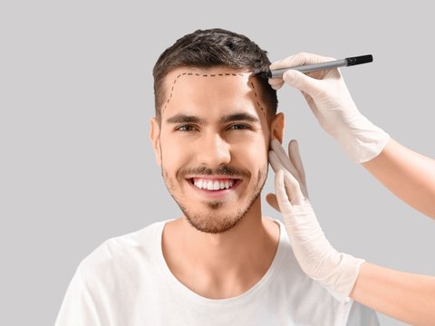 5 Facts about Hair Transplantation Done by Local Celebrities, No Need to Go Far to Turkey