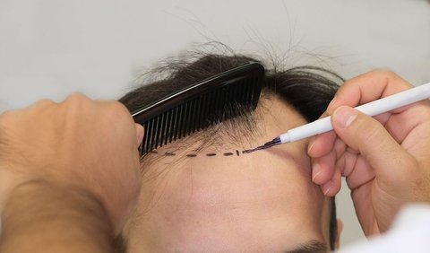 1. What is hair transplantation?