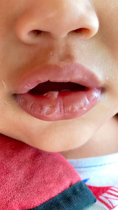 Understanding Lip Blisters in Babies That Often Occur During the Early Stages of Breastfeeding