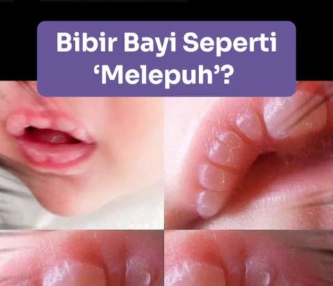 Understanding Lip Blisters in Babies That Often Occur During the Early Stages of Breastfeeding