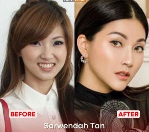 Portrait of the Transformation of Artists Who Undergo Chin Filler Treatment