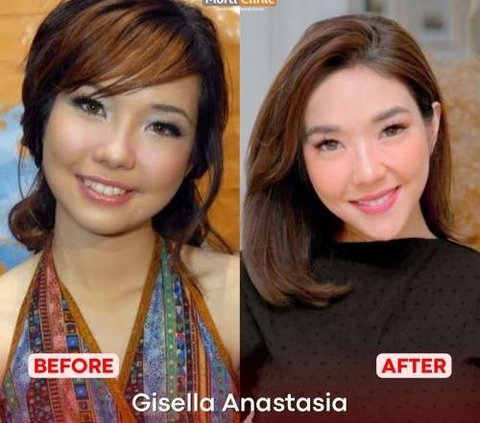 Portrait of the Transformation of Artists Who Undergo Chin Filler Treatment