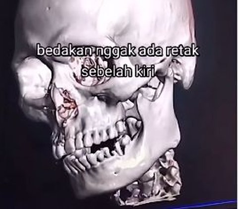 Penampakan Hasil CT Scan Pemotor Kecelakaan, Jelas Bedanya Pakai Helm atau Tidak