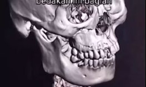 Penampakan Hasil CT Scan Pemotor Kecelakaan, Jelas Bedanya Pakai Helm atau Tidak