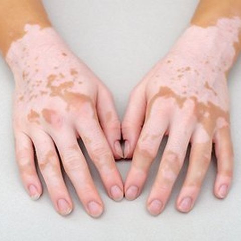 vetiligo