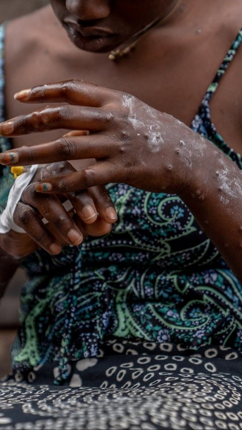 Wabah Mpox menginfeksi ratusan orang di Burundi. Para penderitanya mengharuskan menjalani perawatan di dalam bangsal pusat perawatan Mpox Rumah Sakit Universitas Kamenge di Bujumbura, ibu kota Burundi pada 22 Agustus 2024.