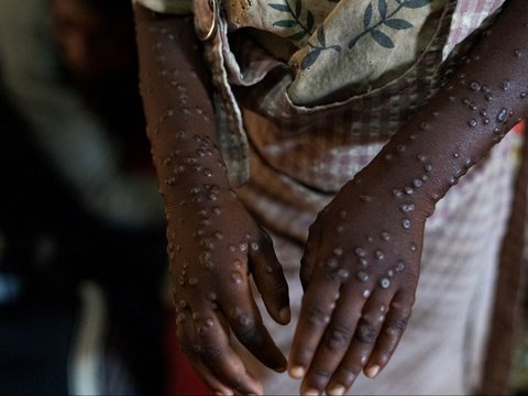 Wabah Mpox menginfeksi ratusan orang di Burundi. Para penderitanya mengharuskan menjalani perawatan di dalam bangsal pusat perawatan Mpox Rumah Sakit Universitas Kamenge di Bujumbura, ibu kota Burundi pada 22 Agustus 2024.