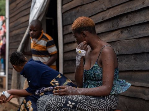 Wabah Mpox menginfeksi ratusan orang di Burundi. Para penderitanya mengharuskan menjalani perawatan di dalam bangsal pusat perawatan Mpox Rumah Sakit Universitas Kamenge di Bujumbura, ibu kota Burundi pada 22 Agustus 2024.