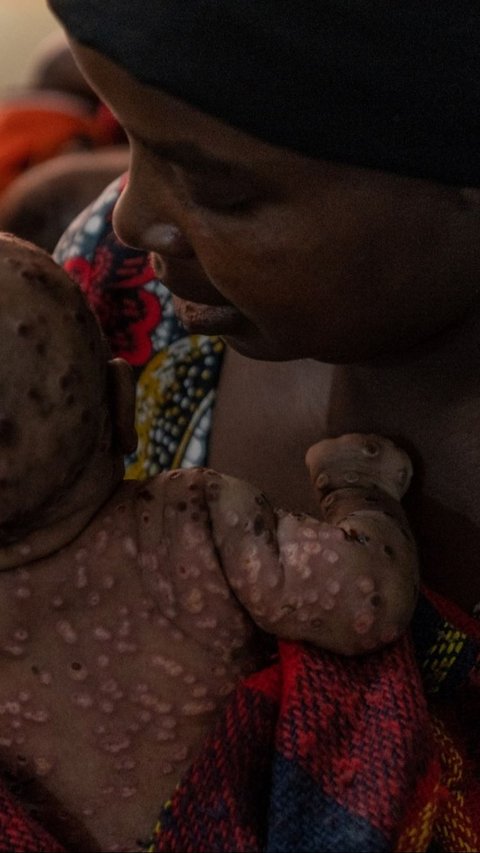Wabah Mpox menginfeksi ratusan orang di Burundi. Para penderitanya mengharuskan menjalani perawatan di dalam bangsal pusat perawatan Mpox Rumah Sakit Universitas Kamenge di Bujumbura, ibu kota Burundi pada 22 Agustus 2024.