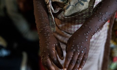 Wabah Mpox menginfeksi ratusan orang di Burundi. Para penderitanya mengharuskan menjalani perawatan di dalam bangsal pusat perawatan Mpox Rumah Sakit Universitas Kamenge di Bujumbura, ibu kota Burundi pada 22 Agustus 2024.