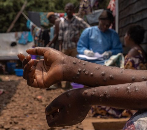 Wabah Mpox menginfeksi ratusan orang di Burundi. Para penderitanya mengharuskan menjalani perawatan di dalam bangsal pusat perawatan Mpox Rumah Sakit Universitas Kamenge di Bujumbura, ibu kota Burundi pada 22 Agustus 2024.