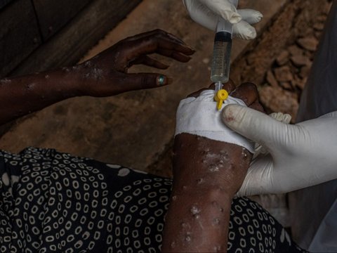 Wabah Mpox menginfeksi ratusan orang di Burundi. Para penderitanya mengharuskan menjalani perawatan di dalam bangsal pusat perawatan Mpox Rumah Sakit Universitas Kamenge di Bujumbura, ibu kota Burundi pada 22 Agustus 2024.