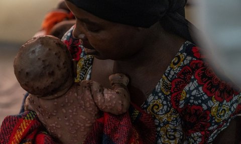 Wabah Mpox menginfeksi ratusan orang di Burundi. Para penderitanya mengharuskan menjalani perawatan di dalam bangsal pusat perawatan Mpox Rumah Sakit Universitas Kamenge di Bujumbura, ibu kota Burundi pada 22 Agustus 2024.
