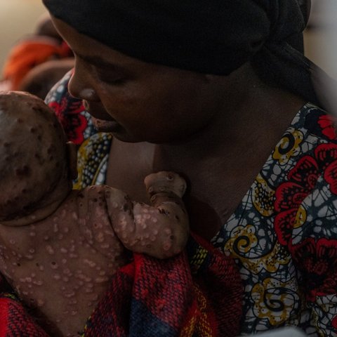 Pembesaran Kelenjar Getah Bening Jadi Ciri Khas Bedakan Mpox dengan Penyakit Lainnya