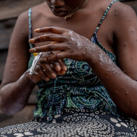 Pola Hidup Bersih Bisa Jadi Kunci Cegah Penularan Mpox