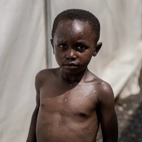 Tiga kasus mpox terdeteksi di Burundi pada akhir Juli, dan kementerian kesehatan melaporkan 153 kasus yang terkonfirmasi pada tanggal 18 Agustus. (Tchandrou NITANGA / AFP)