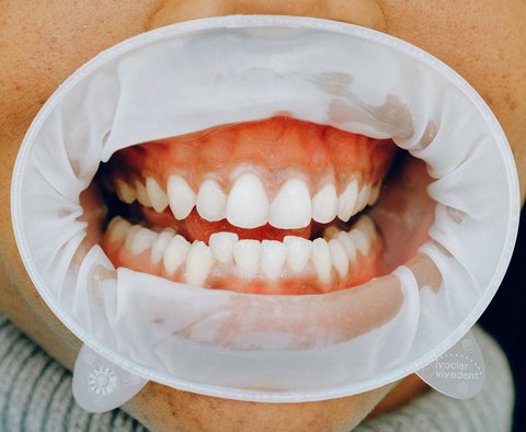 Ilustrasi gusi bengkak/Copyright pexels/Anna Shvets