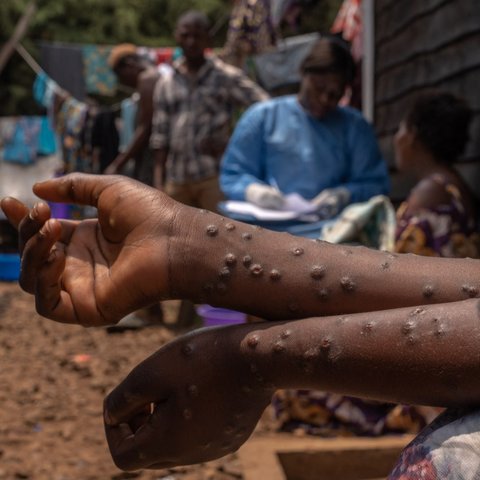 Wabah Mpox menginfeksi ratusan orang di Burundi. Para penderitanya mengharuskan menjalani perawatan di dalam bangsal pusat perawatan Mpox Rumah Sakit Universitas Kamenge di Bujumbura, ibu kota Burundi pada 22 Agustus 2024.