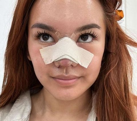 Potret Shafa Harris Oplas Hidung di Korea Selatan, Ambil Tulang dari Iga dan Wajah Minim Bengkak