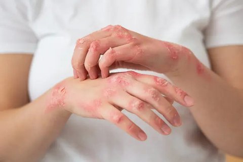 Kantung mata muncul akibat usia, kurang istirahat, atau faktor genetik. Cegah dengan tidur berkualitas, skincare malam, dan perawatan klinis untuk menjaga kulit tetap sehat dan bercahaya. (Il