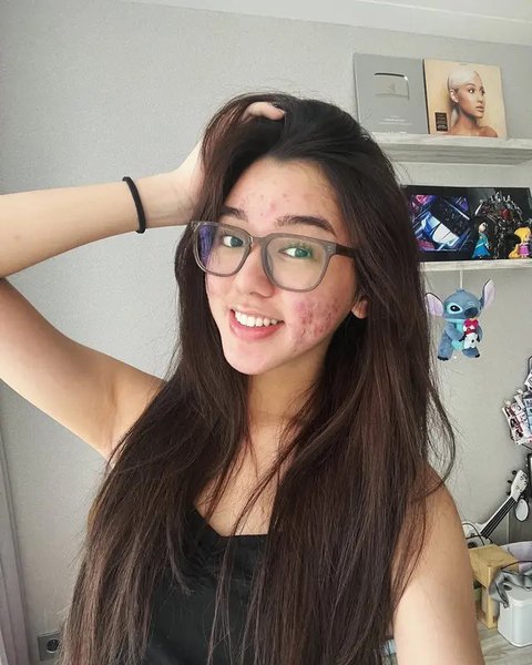 6 Potret Pede Gabriella Ekaputri dengan Wajah Penuh Jerawat, Tak Malu Foto Tanpa Makeup