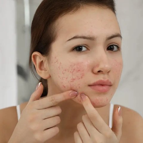 Mengapa orang dewasa masih menemukan jerawat yang bermunculan? Simak di sini alasannya. (iStockphoto)