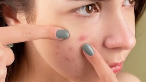 Mengapa orang dewasa masih menemukan jerawat yang bermunculan? Simak di sini alasannya. (iStockphoto)