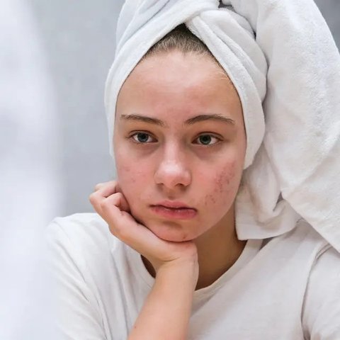 Ilustrasi pori-pori wajah membesar. (c) AllaSerebrina/Depositphotos.com
