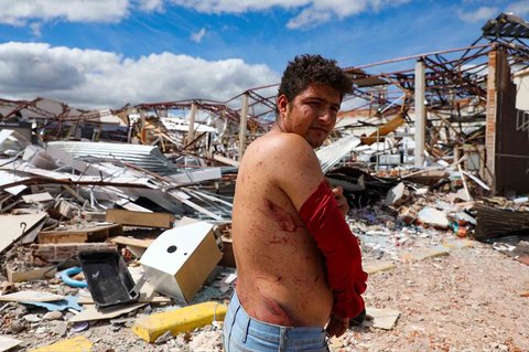 Warga menunjukkan cedera akibat tornado dengan kecepatan angin hingga 250 km/jam yang melanda kota Rio Bonito do Iguacu, di negara bagian Parana, Brasil, Sabtu (08/11/2025) waktu setempat.