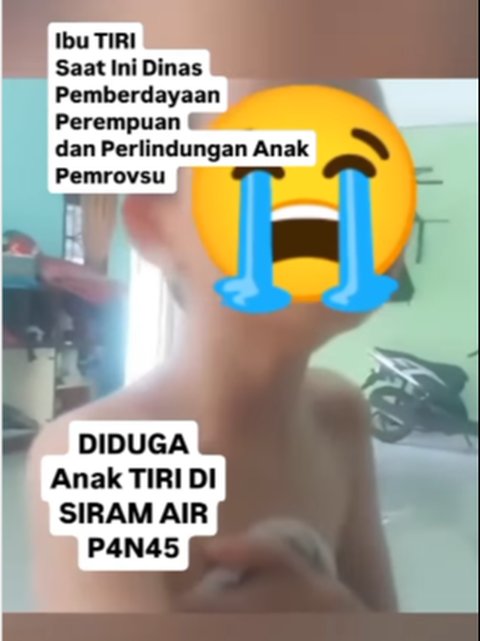 Kejamnya Ibu Tiri Siram Air Panas ke Anak Hingga Kulit Terbakar, Padahal Profesinya ASN Perlindungan Anak