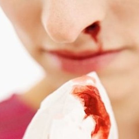 8 Cara Mengatasi Mimisan dengan Cepat dan Mudah, Salah Satunya Gunakan Air Garam