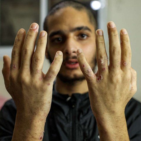 Terungkap Kondisi Miris Tahanan Palestina usai Dibebaskan Israel, Tubuh Kurus dan Penuh Kudis.