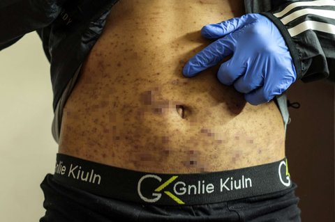 Terungkap Kondisi Miris Tahanan Palestina usai Dibebaskan Israel, Tubuh Kurus dan Penuh Kudis.