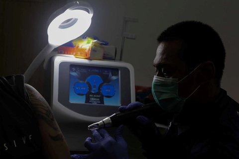 Petugas menggunakan laser untuk menghapus tato seorang pria selama yang mengikuti Layanan Hapus Tato Gratis di Balai Kota DKI Jakarta, Senin (10/3/2025).