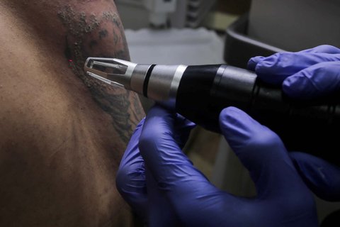 Petugas menggunakan laser untuk menghapus tato seorang pria selama yang mengikuti Layanan Hapus Tato Gratis di Balai Kota DKI Jakarta, Senin (10/3/2025).