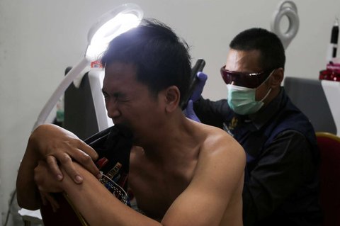 Petugas menggunakan laser untuk menghapus tato seorang pria selama yang mengikuti Layanan Hapus Tato Gratis di Balai Kota DKI Jakarta, Senin (10/3/2025).