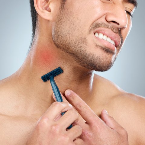 Ilustrasi iritasi setelah bercukur.