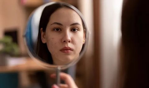 Cara Sederhana Mengatasi Purging pada Kulit Wajah Setelah Penggunaan Skincare Bahan Aktif, Bikin Wajah Lebih Cepat Pulih