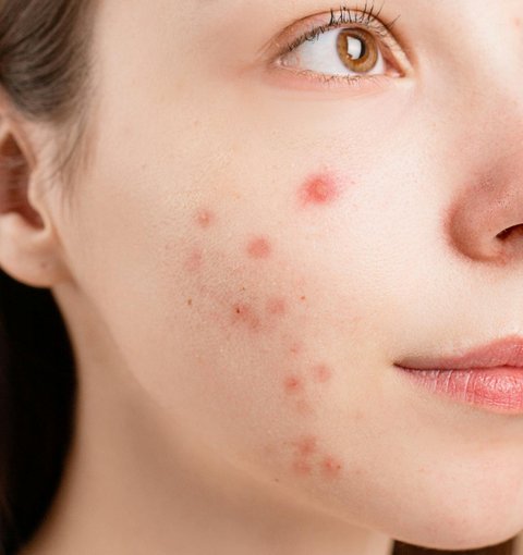 Ilustrasi Kulit Berjerawat