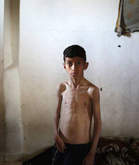 Anak di Gaza Alami Kelaparan