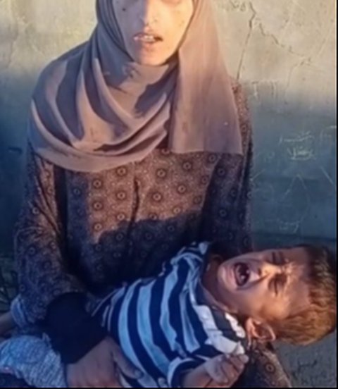 Anak di Gaza Alami Gizi Buruk
