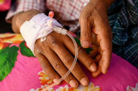 Kondisi tangan Tin Maung Htwe dengan beberapa bekas luka setelah lima hari terkubur reruntuhan gempa Myanmar di Sagaing, pada 3 April 2025. Dua hal yang akhirnya menyelamatkan nyawa guru Tin Maung Htwe ketika berhari-hari tertimbun reruntuhan adalah pengetahuan yang pernah dipelajarinya semasa sekolah dan air kencingnya sendiri.