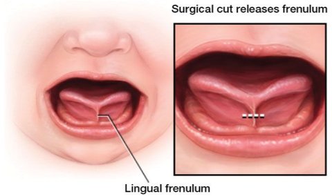 Tongue Tie Bukan Penyebab Utama Speech Delay! Begini Kata Dokter Tumbuh Kembang Anak