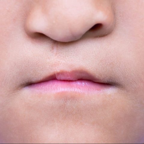 ilustrasi bibir sumbing