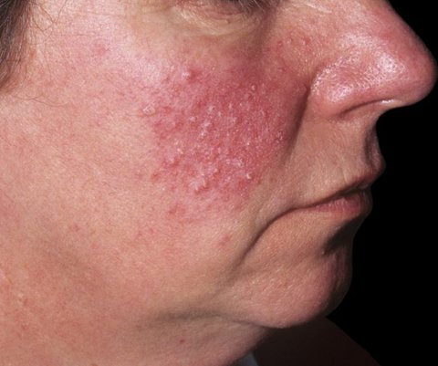 ilustrasi papulopustular rosacea