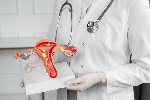 Ilustrasi Endometriosis