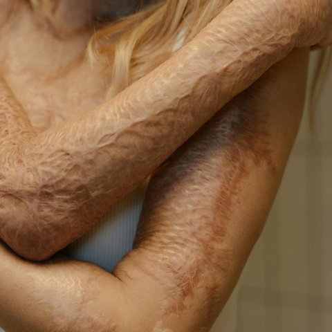 ilustrasi luka bakar